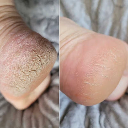 Vitalys Pro - Pédicure électrique nouvelle génération